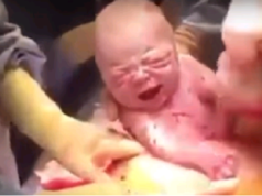 pôrod cisárskym rezom